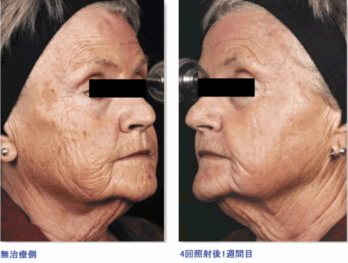 Wholefaceonesidepreandpost_000.gifのサムネール画像