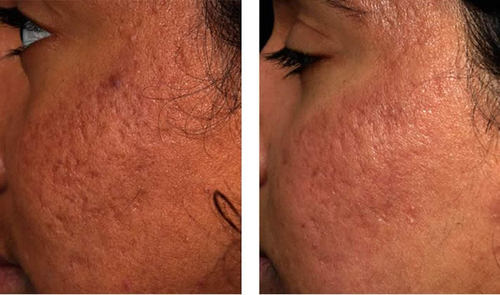 acne4.jpgのサムネール画像
