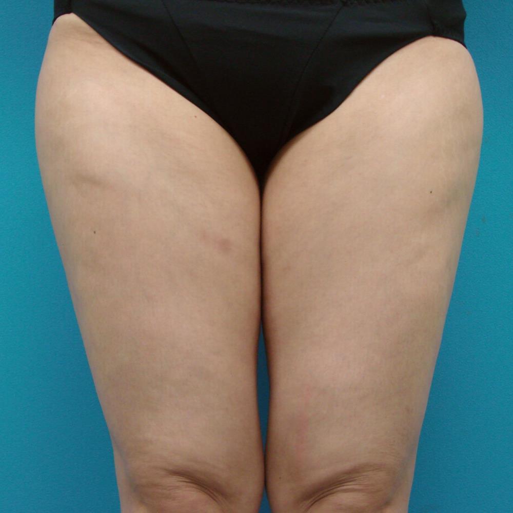 強力脂肪溶解注射 太もも外側と膝周囲 強力脂肪溶解注射