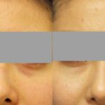目の下のクマ