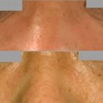 下瞼のタルミ取り